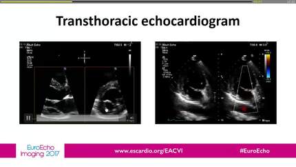 A rare and complex clinical case: double orifice mitral valve, bicuspid aortic valve and aortic coarctation