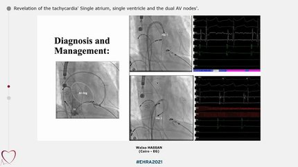Revelation of the tachycardia' Single atrium, single ventricle and the dual AV nodes'.