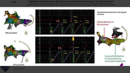 Simplification of resetting response in slow/fast atrioventricular nodal reentrant tachycardia: the 3 catheters approach
