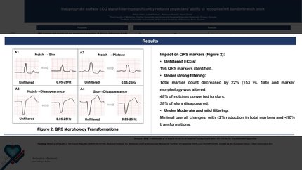Inappropriate surface ECG signal filtering significantly reduces physicians' ability to recognize left bundle branch block