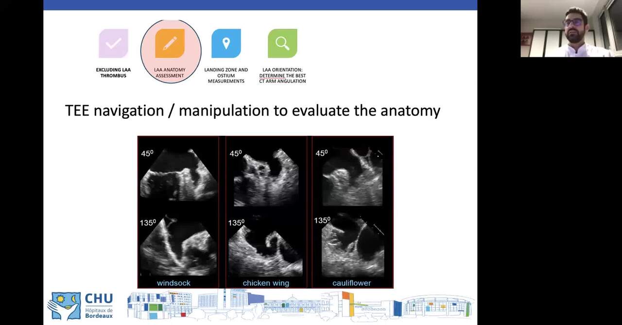 Revealing new insights for the Left Atrium Appendage.