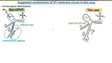 A case of idiopathic ventricular tachycardia originating from the left interventricular septal myocardium mimicking left posterior fascicular ventricular tachycardia