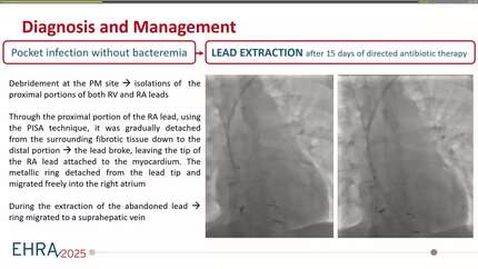 Fragmentation and embolization of pacemaker lead to the liver as a complication of lead extraction