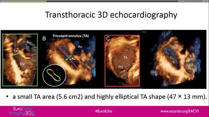 An unrecognized mechanism of functional tricuspid regurgitation revealed by transthoracic three-dimensional echocardiography