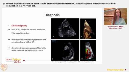 Hidden depths- more than heart failure after myocardial infarction.  A new diagnosis of left ventricular non-compaction in a 46-year-old.