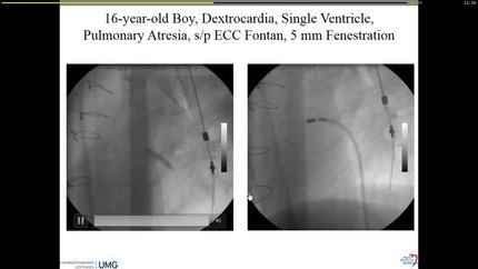 Arrhythmias and catheter ablation in single ventricle patients.