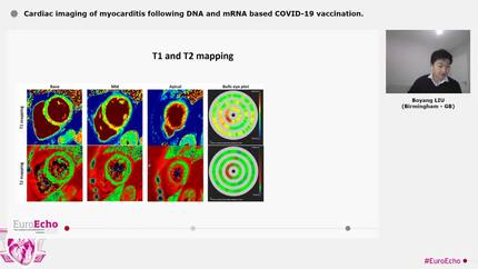 Cardiac imaging of myocarditis following DNA and mRNA based COVID-19 vaccination.