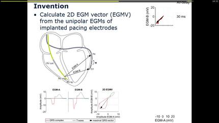 EHRA Inventor Award: Tailor-CRT: optimising AV-delay for LV-pacing using electrogram signals