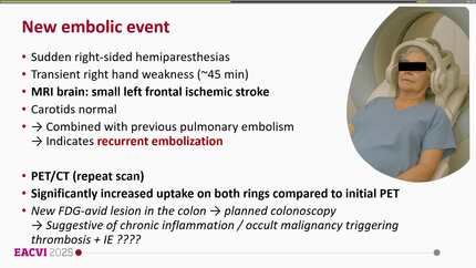 Culture-negative mass on prosthetic mitral and tricuspid valves: , degeneration,  endocarditis or thrombus?