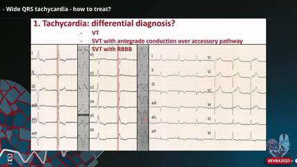 Wide QRS tachycardia - how to treat?
