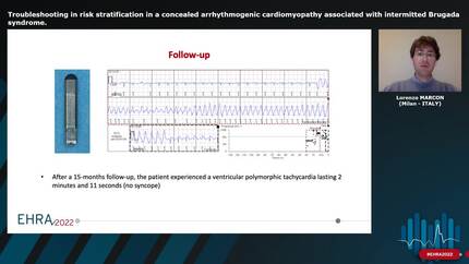 Troubleshooting in risk stratification in a concealed arrhythmogenic cardiomyopathy associated with intermitted Brugada syndrome.