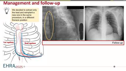 If it doesn't work, try it different: a subcutaneous implantable cardioverter defibrillator infection case report. 