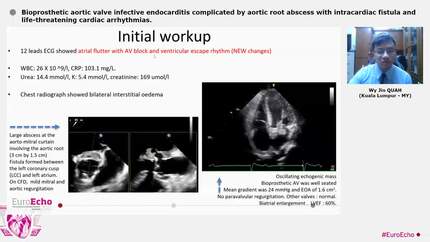Bioprosthetic aortic valve infective endocarditis complicated by aortic root abscess with intracardiac fistula and life-threatening cardiac arrhythmias.