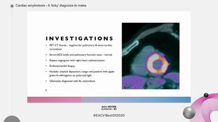 Cardiac amyloidosis - A 'ticky' diagnosis to make.
