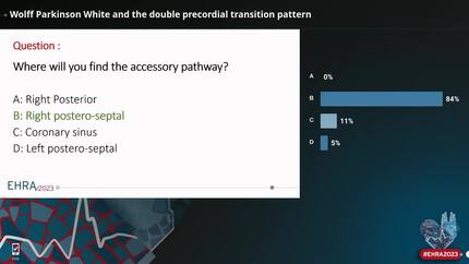 Wolff Parkinson White  and the double precordial transition pattern 
