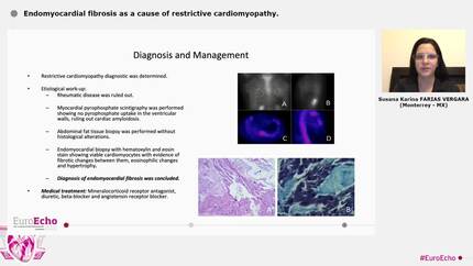 Endomyocardial fibrosis as a cause of restrictive cardiomyopathy.