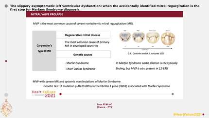 The slippery asymptomatic left ventricular dysfunction: when the accidentally identified mitral regurgitation is the first step for Marfans Syndrome diagnosis.
