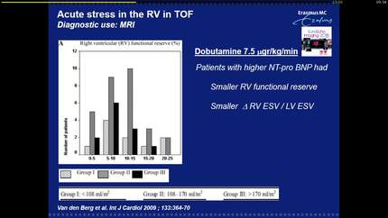 Stressing the right ventricle.