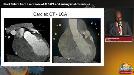 Heart failure from a rare case of ALCAPA and aneurysmal coronaries