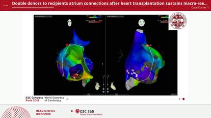 Double donors to recipients atrium connections after heart transplantation sustains macro-reentrant atrial tachycardia.