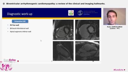 Biventricular arrhythmogenic cardiomyopathy: a review of the clinical and imaging hallmarks.
