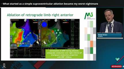 Nightmares in supraventricular tachycardia ablation