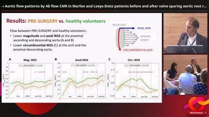 Aortic flow patterns by 4D flow CMR in Marfan and Loeys-Dietz patients before and after valve sparing aortic root replacement: a comparison with healthy volunteers