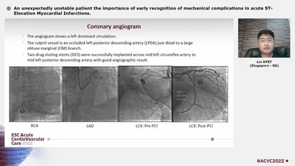 An unexpectedly unstable patient the importance of early recognition of mechanical complications in acute ST-Elevation Myocardial Infarctions.