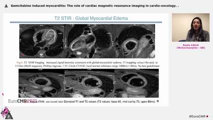 Gemcitabine induced myocarditis: The role of cardiac magnetic resonance imaging in cardio-oncology.
.