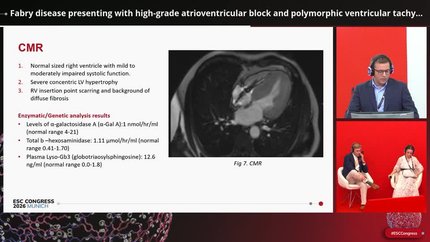 Fabry disease presenting with high-grade atrioventricular block and polymorphic ventricular tachycardia