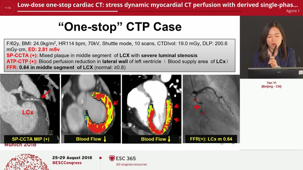 Low-dose one-stop cardiac CT: stress dynamic myocardial CT perfusion with derived single-phase coronary CT angiography: validation by fractional flow reserve
