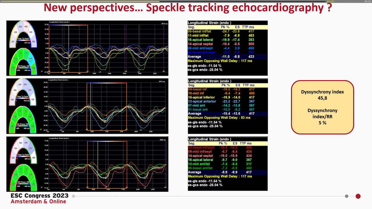 Supraventricular tachycardia (1)