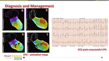 A complex case of polymorphic premature ventricular complexes causing severe heart failure symptoms