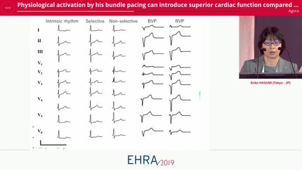 Physiological activation by his bundle pacing can introduce superior cardiac function compared with right or bi-ventricular pacing. a simulation study using a realistic computer heart model.