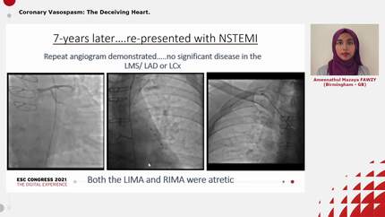 Coronary Vasospasm: The Deceiving Heart.