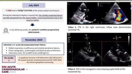 Rescue TTVR with a new-sized EVOQUE valve following transcatheter edge-to-edge repair