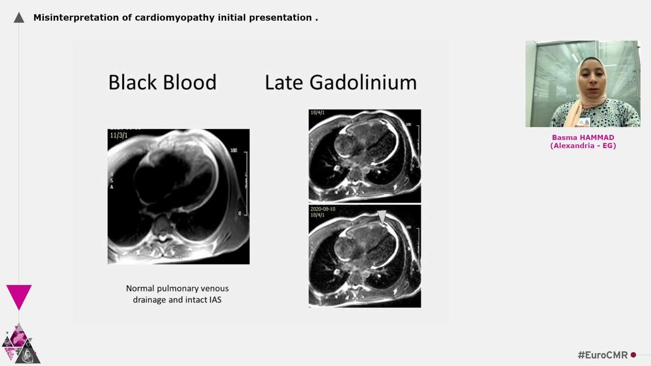 Misinterpretation of cardiomyopathy initial  presentation
.