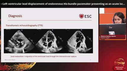Left ventricular lead displacement of endovenous His-bundle pacemaker presenting as an acute ischaemic stroke 
