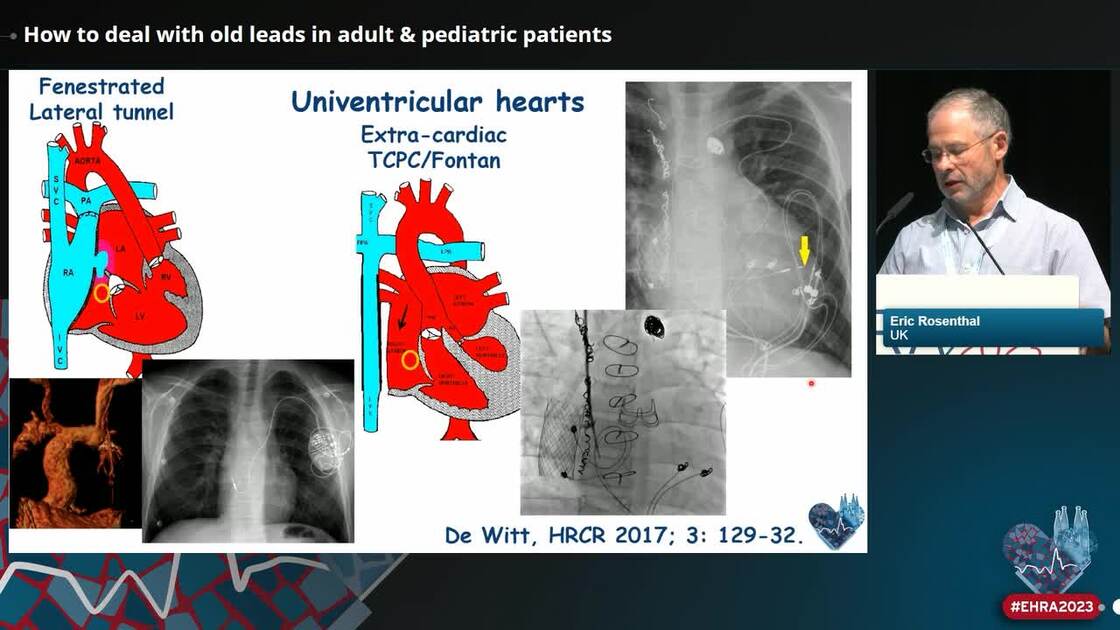 Esc 365 how to deal with old leads in adult pediatric patients