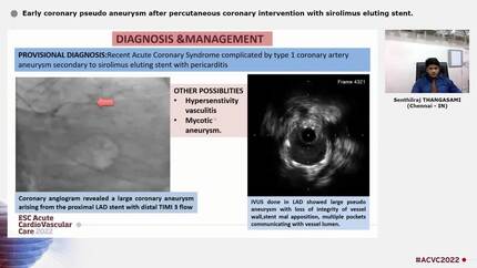 Early coronary pseudo aneurysm after  percutaneous coronary intervention with sirolimus eluting stent.