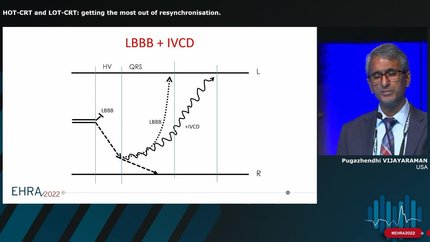 Conduction system pacing: ready for prime time?
