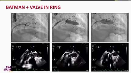 BATMAN to the rescue: facilitating valve-in-ring TMVR in a high-risk patient
