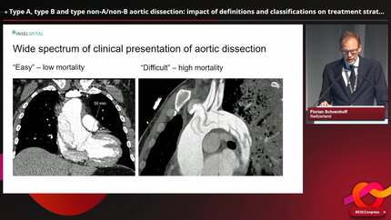 Type A, type B and type non-A/non-B aortic dissection: impact of definitions and classifications on treatment strategies.