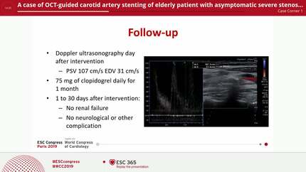 A case of OCT-guided carotid artery stenting of elderly patient with asymptomatic severe stenosis of internal carotid artery: the future gold standard?