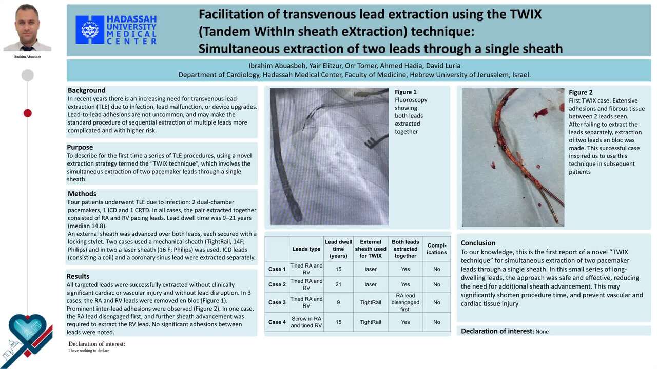 Facilitation of transvenous lead extraction using the TWIX technique: simultaneous extraction of two leads through a single sheath