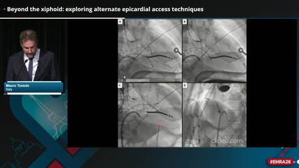 Beyond the xiphoid: exploring alternate epicardial access techniques