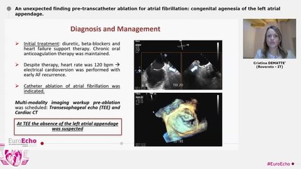 An unexpected finding pre-transcatheter ablation for atrial fibrillation: congenital agenesia of the left atrial appendage.