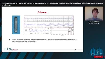 Troubleshooting in risk stratification in a concealed arrhythmogenic cardiomyopathy associated with intermitted Brugada syndrome.
