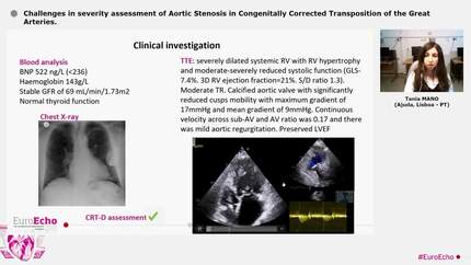 Challenges in severity assessment of Aortic Stenosis in Congenitally Corrected Transposition of the Great Arteries.