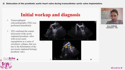 Dislocation of the prosthetic aortic heart valve during transcatheter aortic valve implantation.